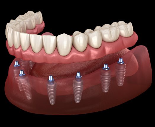 A 3D illustration of a full implant denture