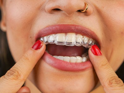 A woman placing an Invisalign tray in her mouth