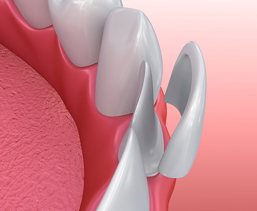 A 3D illustration of a veneer being placed