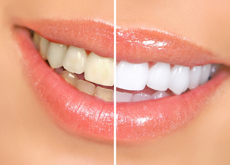 A before-and-after photo of a patient’s teeth whitening treatment