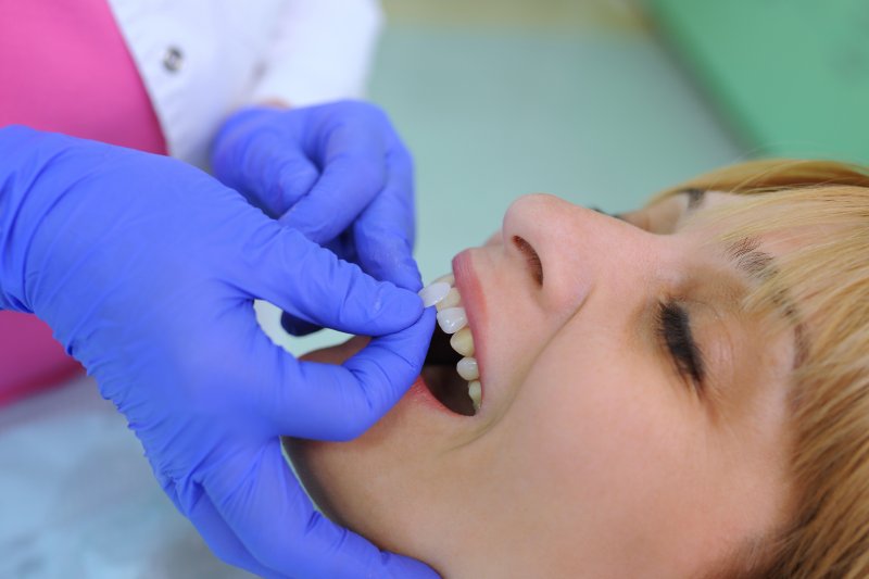 A dentist placing veneers on a woman’s teeth